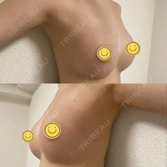 豊胸（シリコン＋脂肪併用） Casa de GRACIA GINZA 【カーサデグラシアギンザ】 DAY 253 メイン用