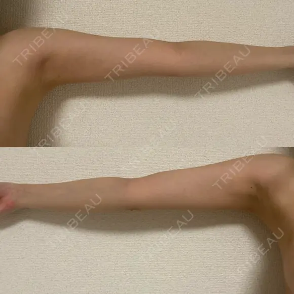 豊胸（シリコン＋脂肪併用） Casa de GRACIA GINZA 【カーサデグラシアギンザ】 DAY 253 メイン用