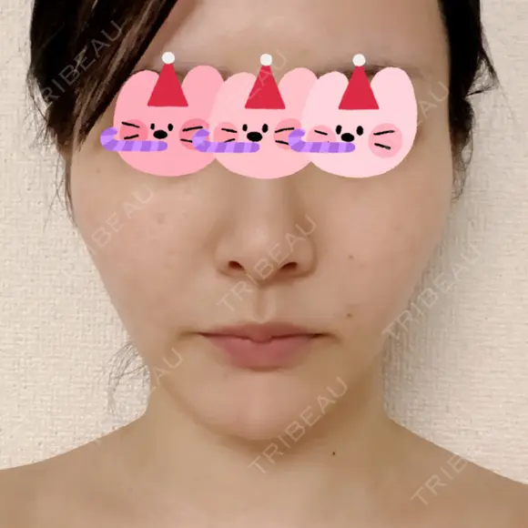 糸リフト / 脂肪吸引（顔） 東京美専クリニック AFTER メイン用