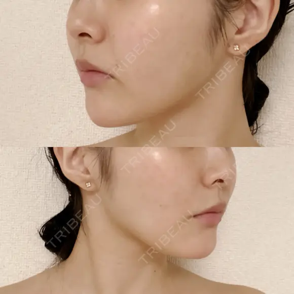 糸リフト / 脂肪吸引（顔） 東京美専クリニック DAY 85 メイン用