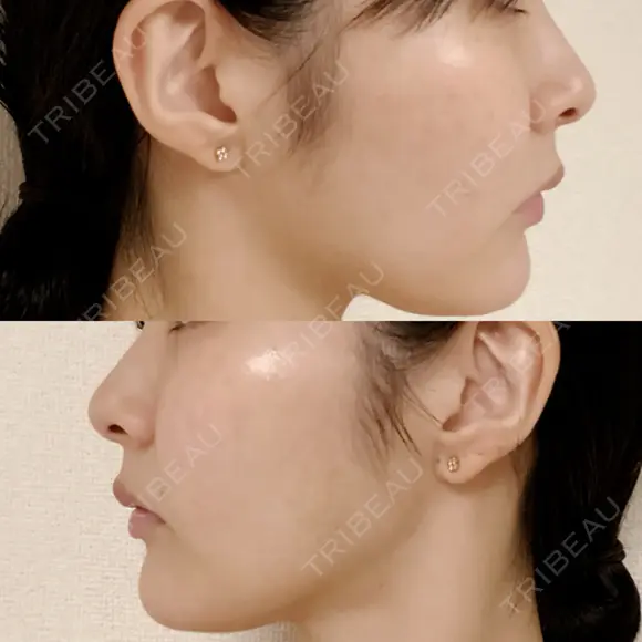 糸リフト / 脂肪吸引（顔） 東京美専クリニック DAY 85 メイン用