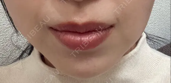 ヒアルロン酸注入（鼻翼基部） ルラ美容クリニック 名古屋本院 DAY 11 メイン用