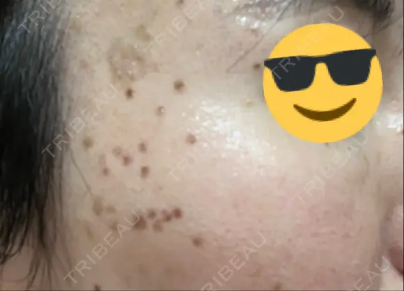 シミ取りレーザー / ピコスポット Olino美容外科・美容皮膚科 DAY 4 メイン用