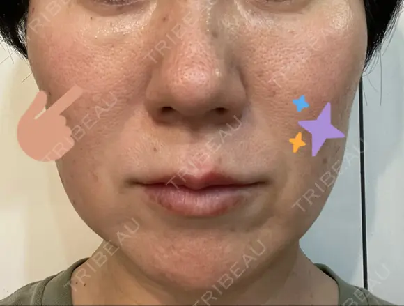 シミ取りレーザー / ピコスポット Olino美容外科・美容皮膚科 DAY 6 メイン用