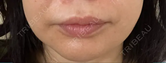 ボトックス（口角） / ボトックス（人中） S-Laboクリニック 渋谷院 AFTER メイン用