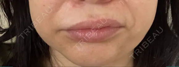 ボトックス（口角） / ボトックス（人中） S-Laboクリニック 渋谷院 DAY 10 メイン用