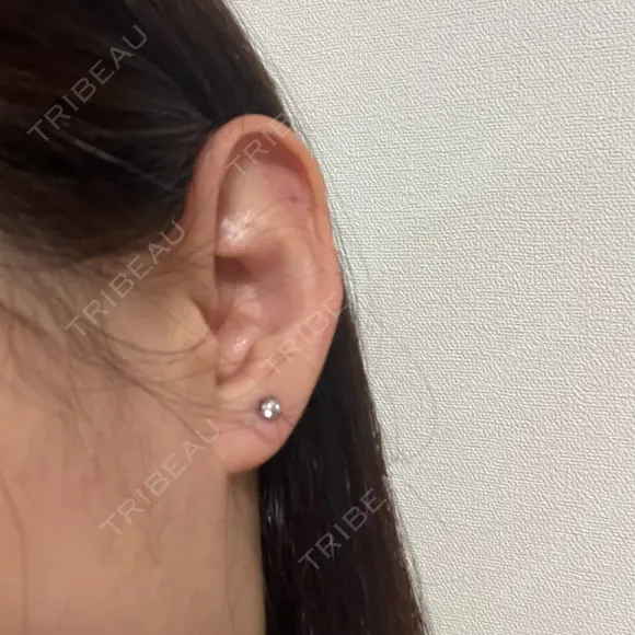 ピアス穴あけ 新宿ラクル美容外科クリニック 六本木院 AFTER メイン用