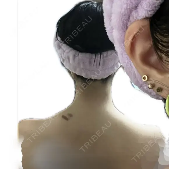 ボトックス（あご） / ボトックス（肩） ルラ美容クリニック 札幌本院 AFTER メイン用