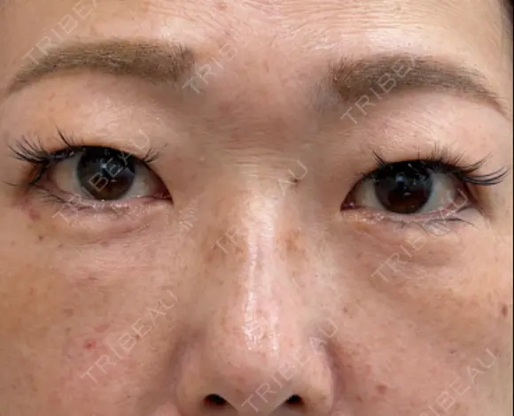下まぶたたるみ取り / 下まぶたの脂肪取り / 脂肪注入（目の下） 湘南美容クリニック 千葉センシティ院 DAY 8 メイン用