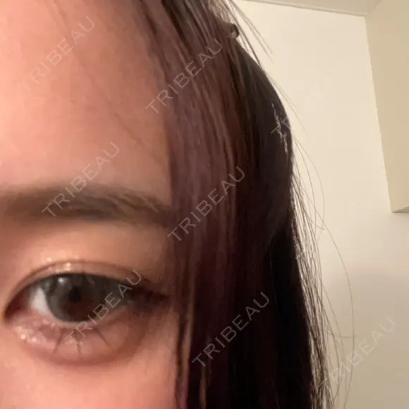 ヒアルロン酸注入（涙袋） ファイヤークリニック 銀座院 DAY 2 メイン用