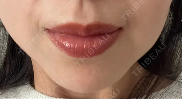 ヒアルロン酸注入（鼻翼基部） ルラ美容クリニック 名古屋本院 DAY 12 メイン用