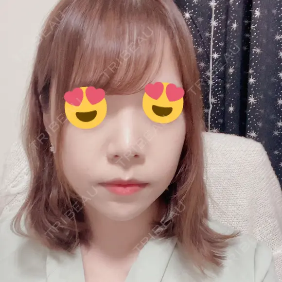 鼻尖形成（切開） / 軟骨移植 / ヒアルロン酸注入（鼻） / ヒアルロン酸注入（あご） ASTRA BEAUTY CLINIC DAY 5 メイン用