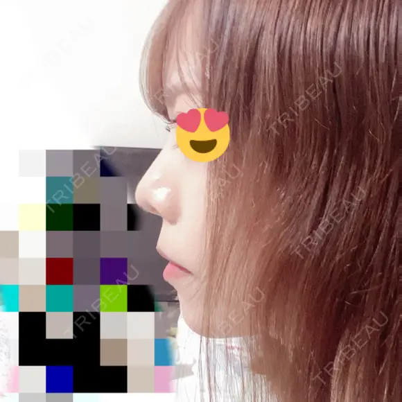 鼻尖形成（切開） / 軟骨移植 / ヒアルロン酸注入（鼻） / ヒアルロン酸注入（あご） ASTRA BEAUTY CLINIC DAY 5 メイン用
