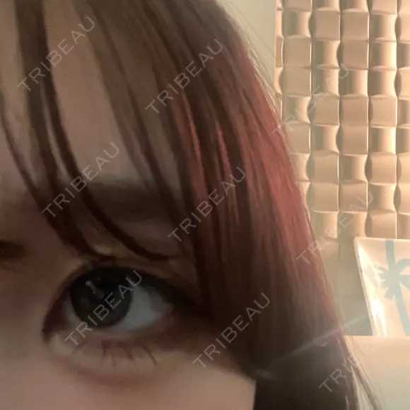 ヒアルロン酸注入（涙袋） ファイヤークリニック 銀座院 DAY 3 メイン用