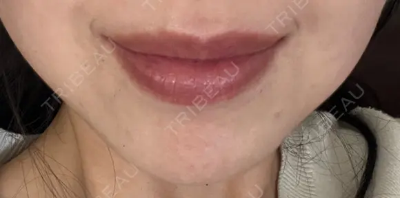 ボトックス（あご） ルラ美容クリニック 名古屋本院 DAY 4 メイン用