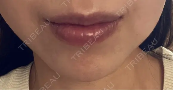 ボトックス（あご） ルラ美容クリニック 名古屋本院 DAY 5 メイン用