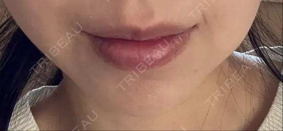 ボトックス（あご） ルラ美容クリニック 名古屋本院 DAY 6 メイン用