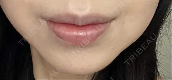 ボトックス（あご） ルラ美容クリニック 名古屋本院 DAY 7 メイン用