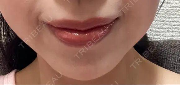 ボトックス（あご） ルラ美容クリニック 名古屋本院 DAY 9 メイン用