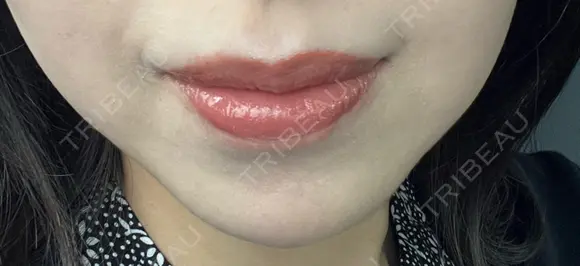 ボトックス（あご） ルラ美容クリニック 名古屋本院 DAY 10 メイン用