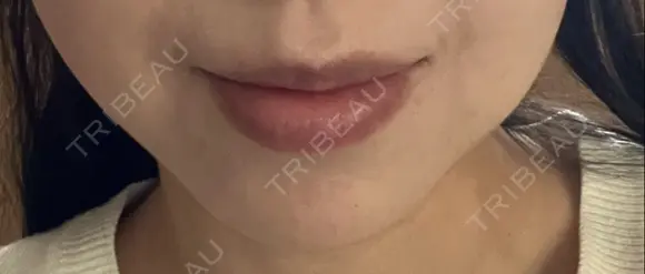 ボトックス（あご） ルラ美容クリニック 名古屋本院 DAY 11 メイン用