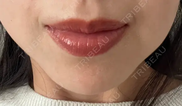 ボトックス（あご） ルラ美容クリニック 名古屋本院 AFTER メイン用