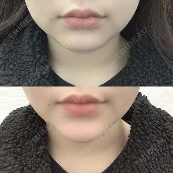 ヒアルロン酸注入（あご） / ボトックス（エラ・小顔） TCB東京中央美容外科 堺院 DAY 0 メイン用