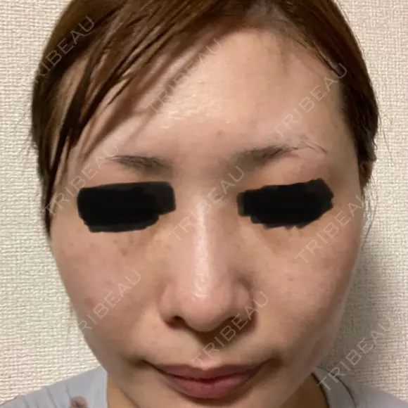 美肌レーザー / ピコレーザートーニング（美白・肝斑） CLINIC W AFTER メイン用
