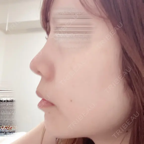 鼻尖形成（切開） / 軟骨移植 / ヒアルロン酸注入（鼻） / ヒアルロン酸注入（あご） ASTRA BEAUTY CLINIC DAY 6 メイン用