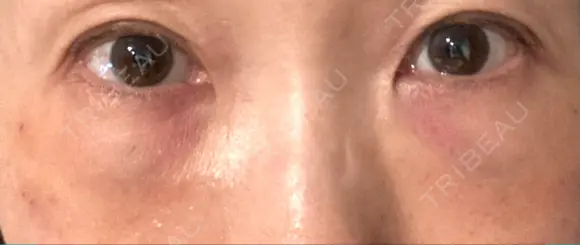 下まぶたの脂肪取り / 脂肪注入（肌） / 脂肪注入（目の下） X CLINIC 大阪院 DAY 1 メイン用