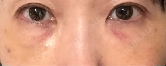 下まぶたの脂肪取り / 脂肪注入（肌） / 脂肪注入（目の下） X CLINIC 大阪院 DAY 2 メイン用