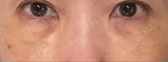 下まぶたの脂肪取り / 脂肪注入（肌） / 脂肪注入（目の下） X CLINIC 大阪院 DAY 3 メイン用