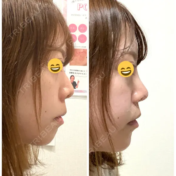 鼻尖形成（切開） / 軟骨移植 / ヒアルロン酸注入（鼻） / ヒアルロン酸注入（あご） ASTRA BEAUTY CLINIC DAY 6 メイン用