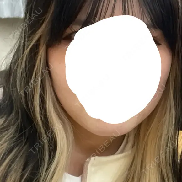ボトックス（エラ・小顔） さっぽろ美容クリニック AFTER メイン用