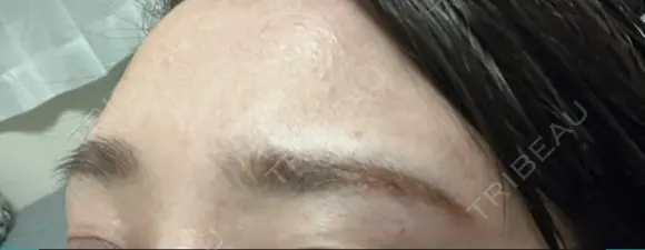 アートメイク除去・修正 LEAGRANT CLINIC 中目黒 DAY 3 メイン用