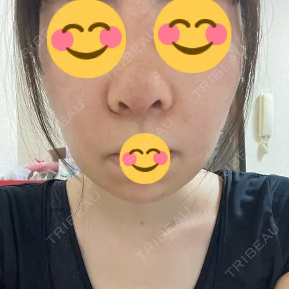 鼻尖形成（切開） / 鼻中隔延長（切開） / 小鼻縮小（切開） / バッカルファット除去 / 脂肪吸引（顔） / 軟骨移植 / 眉間プロテーゼ / 鼻尖縮小 ジョウクリニック 大阪院 DAY 13 メイン用
