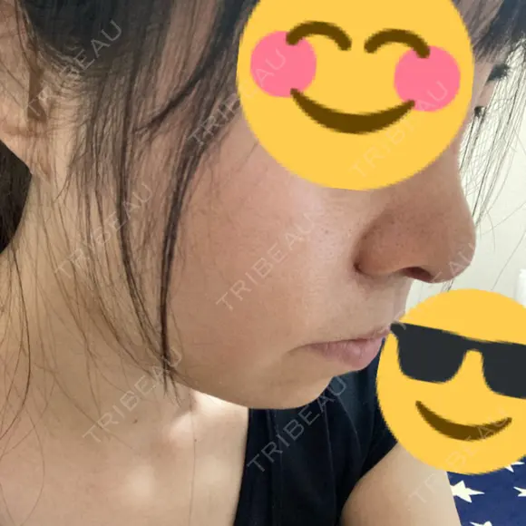 鼻尖形成（切開） / 鼻中隔延長（切開） / 小鼻縮小（切開） / バッカルファット除去 / 脂肪吸引（顔） / 軟骨移植 / 眉間プロテーゼ / 鼻尖縮小 ジョウクリニック 大阪院 DAY 13 メイン用