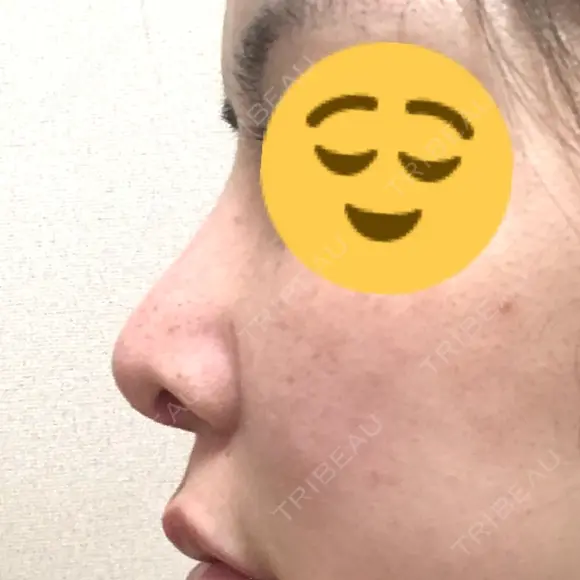 鼻尖形成（切開） / 軟骨移植 / 骨切幅寄せ / 鼻修正 / その他（鼻） 表参道スキンクリニック 表参道院 DAY 24 メイン用