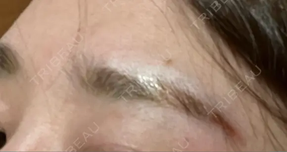 アートメイク除去・修正 LEAGRANT CLINIC 中目黒 DAY 5 メイン用