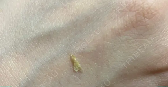 アートメイク除去・修正 LEAGRANT CLINIC 中目黒 DAY 5 メイン用