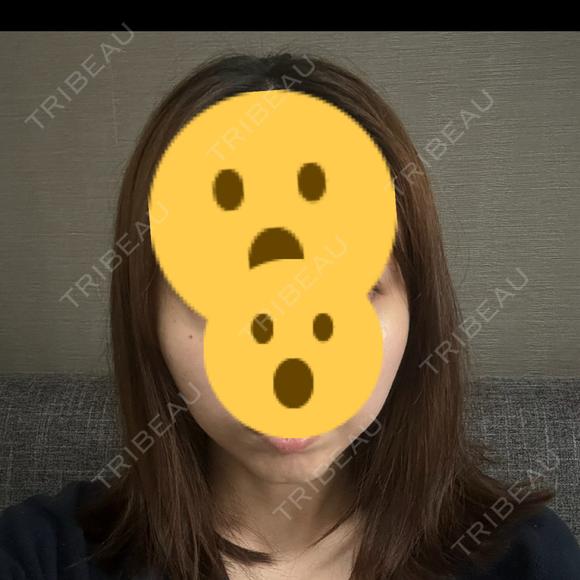 ボトックス（エラ・小顔） TCB東京中央美容外科 自由が丘院 DAY 24 メイン用