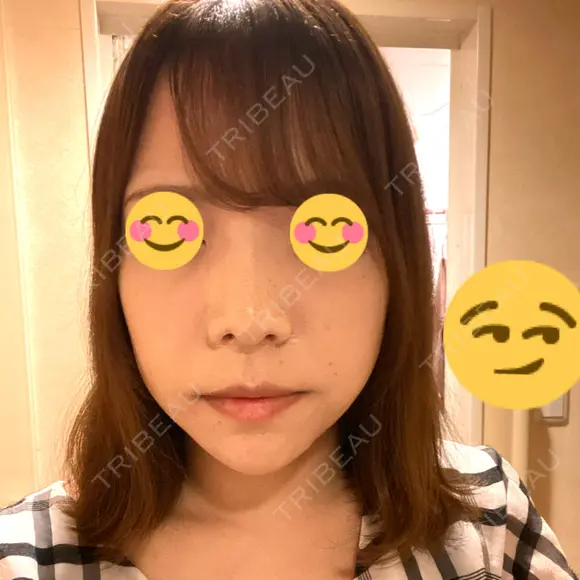 鼻尖形成（切開） / 軟骨移植 / ヒアルロン酸注入（鼻） / ヒアルロン酸注入（あご） ASTRA BEAUTY CLINIC DAY 7 メイン用