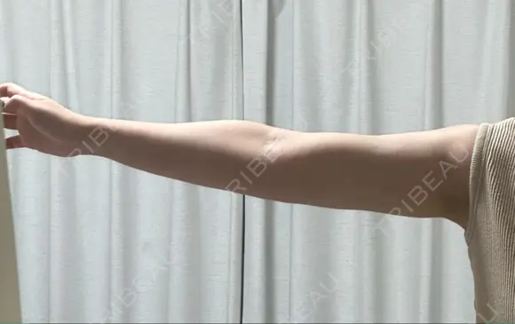 脂肪吸引（二の腕） / 脂肪吸引（脚） / ボトックス（ふくらはぎ） / ボトックス（二の腕） Mods Clinic（モッズクリニック） 福岡院 DAY 197 メイン用