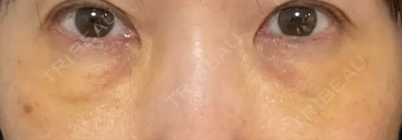 下まぶたの脂肪取り / 脂肪注入（肌） / 脂肪注入（目の下） X CLINIC 大阪院 DAY 4 メイン用