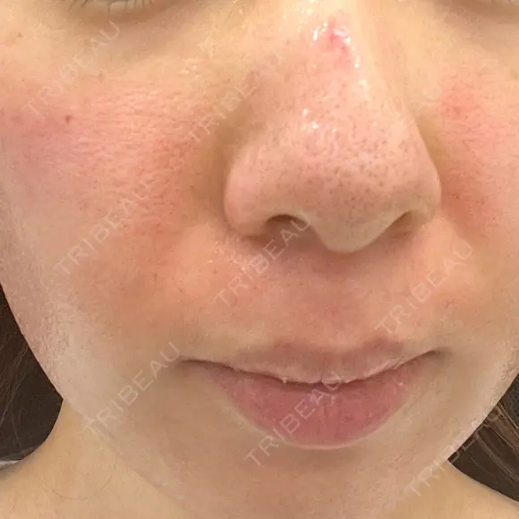 ヴェルヴェットスキン 東京シンデレラ美容外科 大宮院 AFTER メイン用