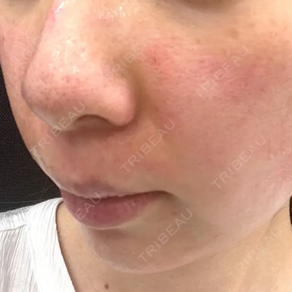 ヴェルヴェットスキン 東京シンデレラ美容外科 大宮院 DAY 0 メイン用