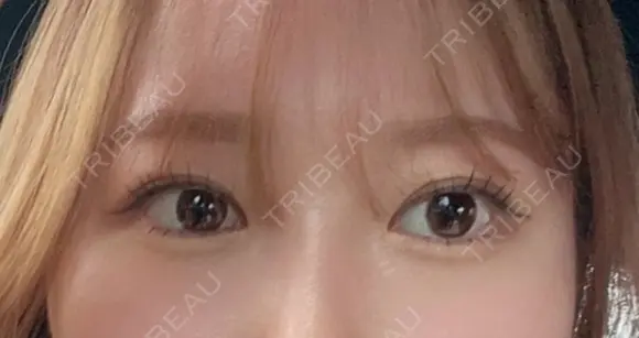 二重切開 Olino美容外科・美容皮膚科 DAY 48 メイン用