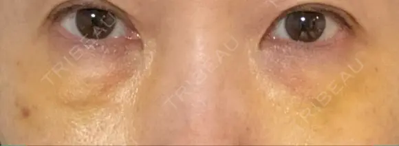 下まぶたの脂肪取り / 脂肪注入（肌） / 脂肪注入（目の下） X CLINIC 大阪院 DAY 5 メイン用