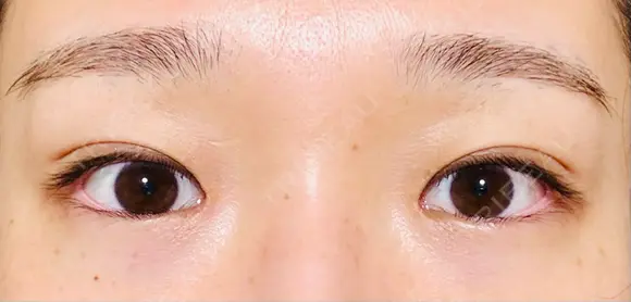 目頭切開 / 自然癒着法 / 眼瞼下垂（非切開） LUHO（ルホ）美容外科 DAY 30 メイン用