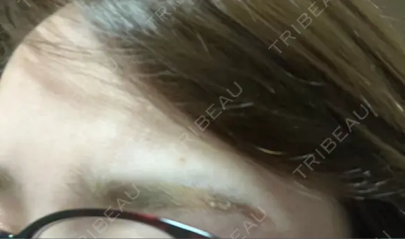 アートメイク除去・修正 LEAGRANT CLINIC 中目黒 DAY 6 メイン用